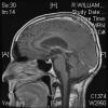 ependymoma 2+ years